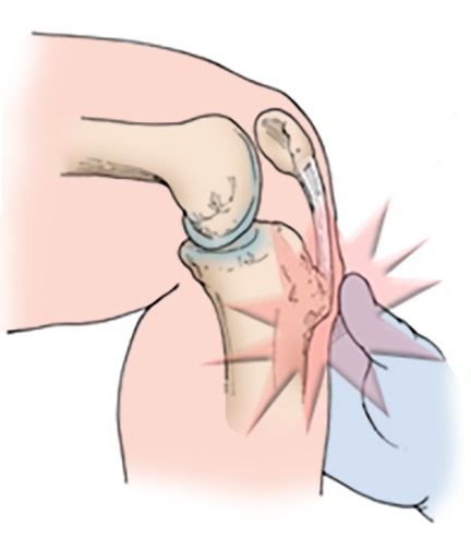What is Osgood-Schlatters Disease (OSD) or Growing Pains in Active Children?
