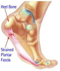 Successful Cure for Plantar Fasciitis